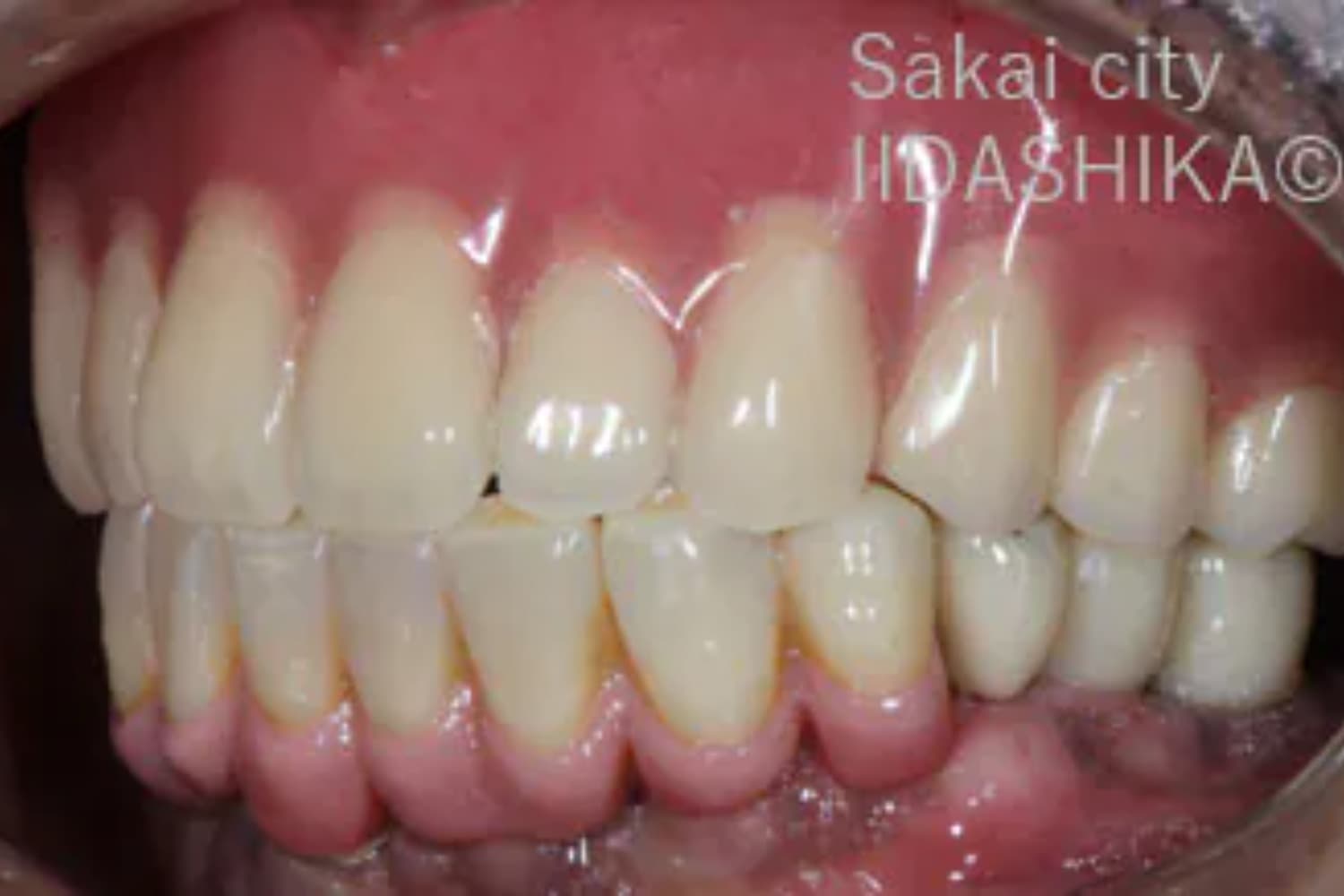 症例④インプラント治療後