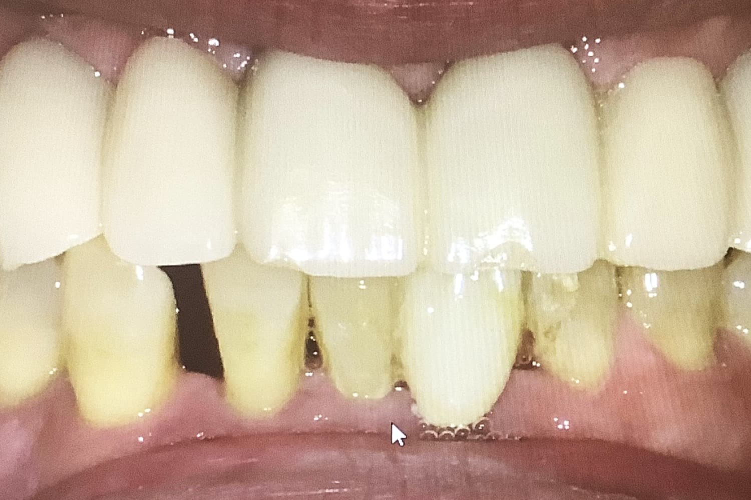インプラント治療後