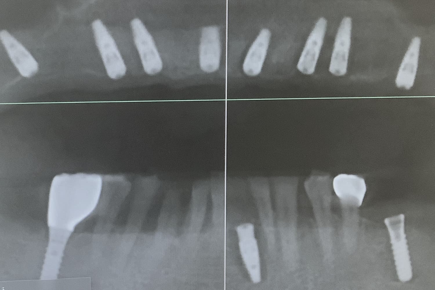 インプラント治療後(レントゲン)