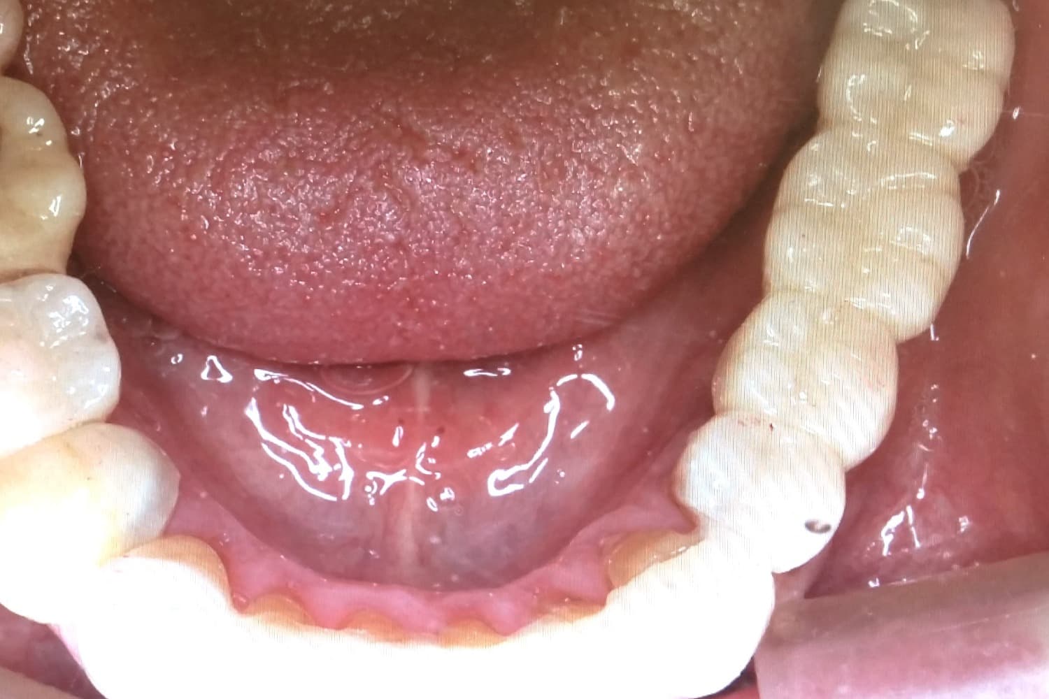 インプラント治療後