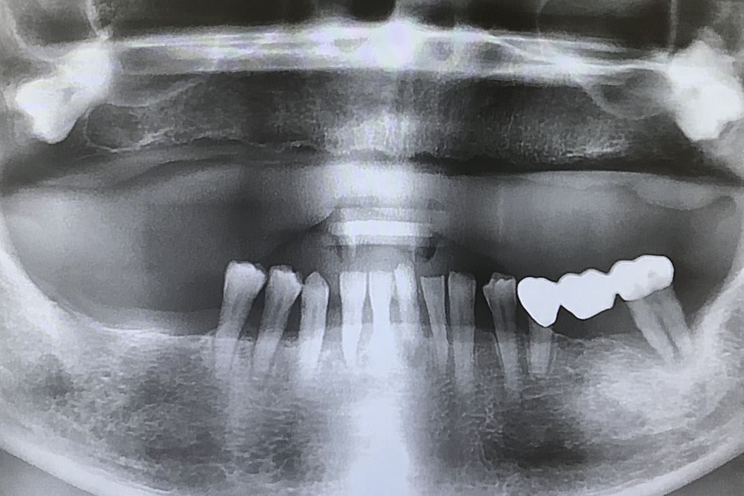インプラント治療前(レントゲン)