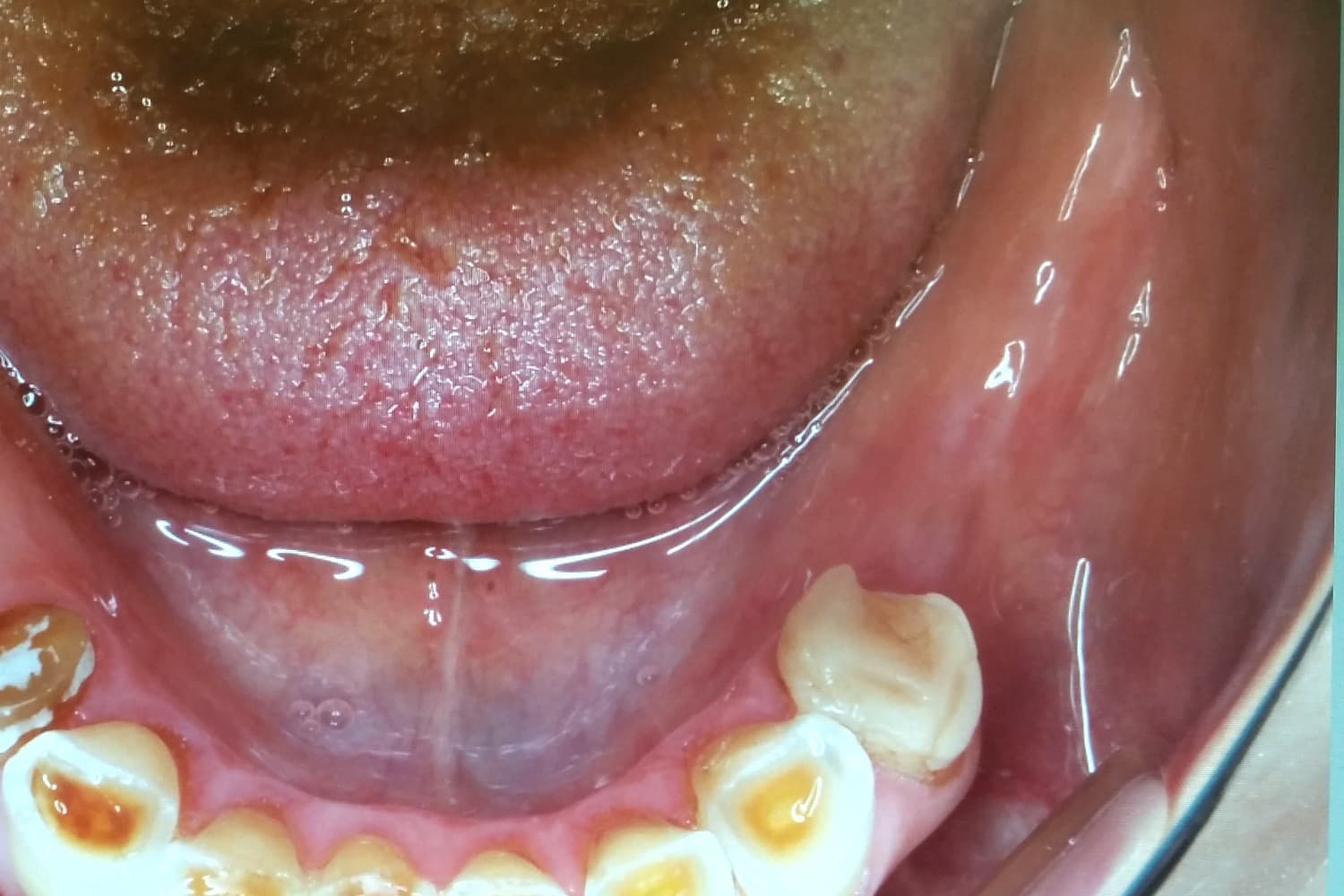 インプラント治療前