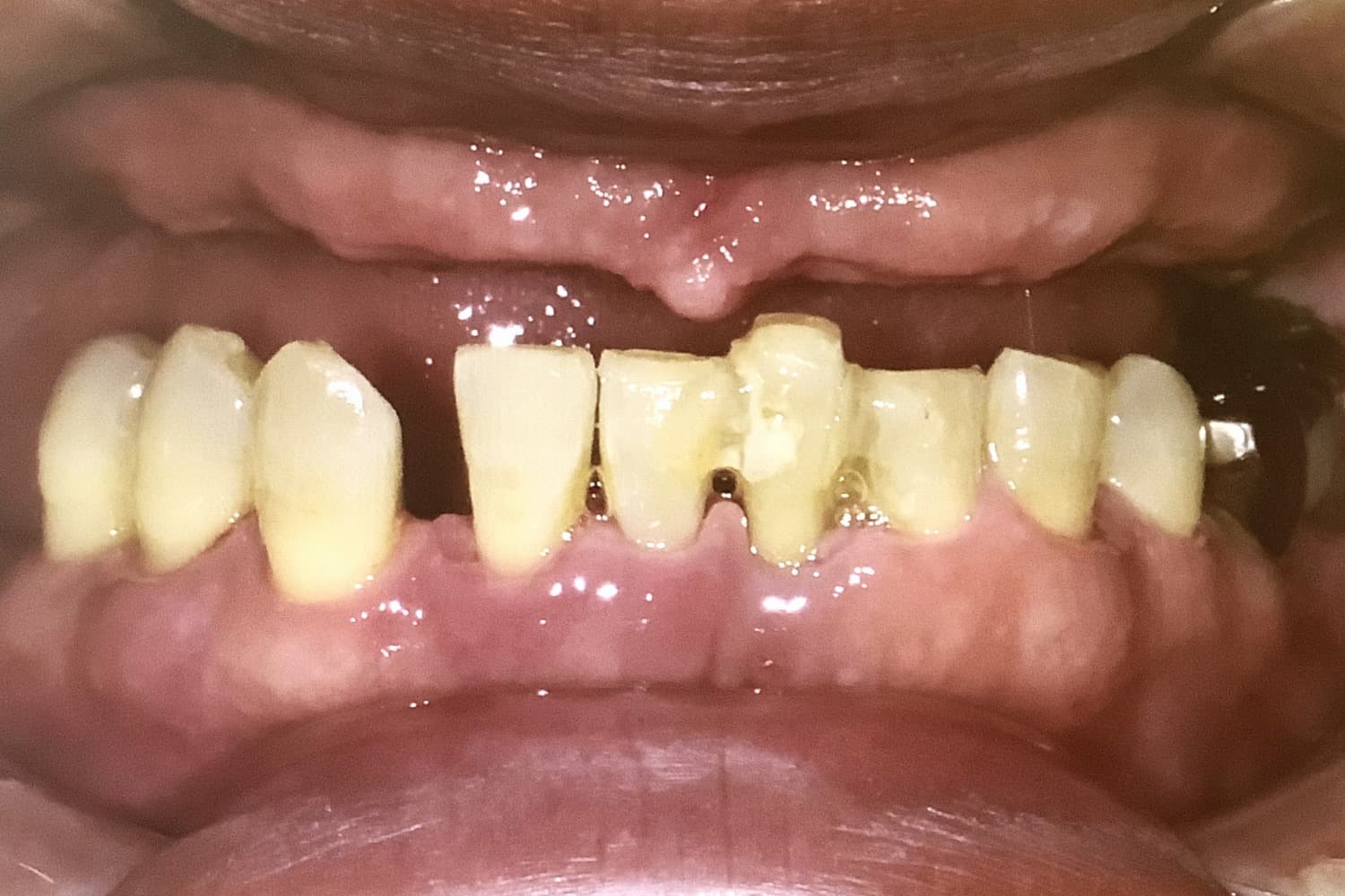 インプラント治療前