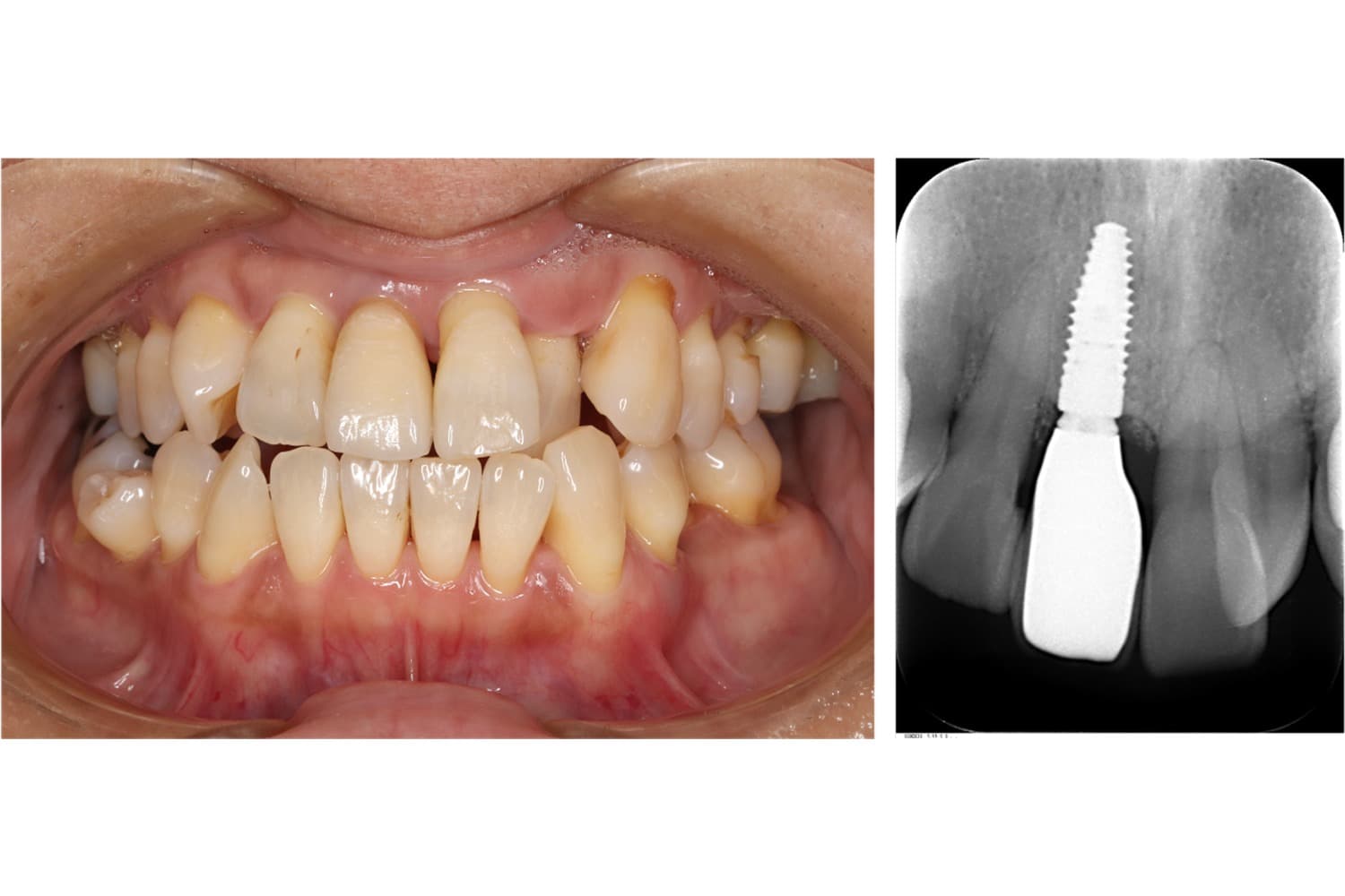 インプラント治療後