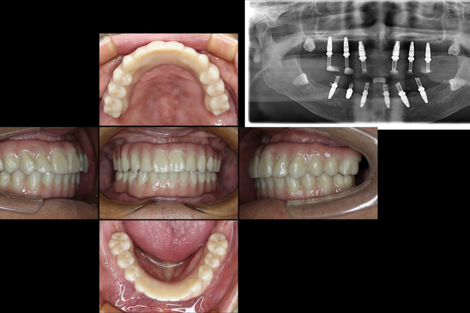 インプラント治療後