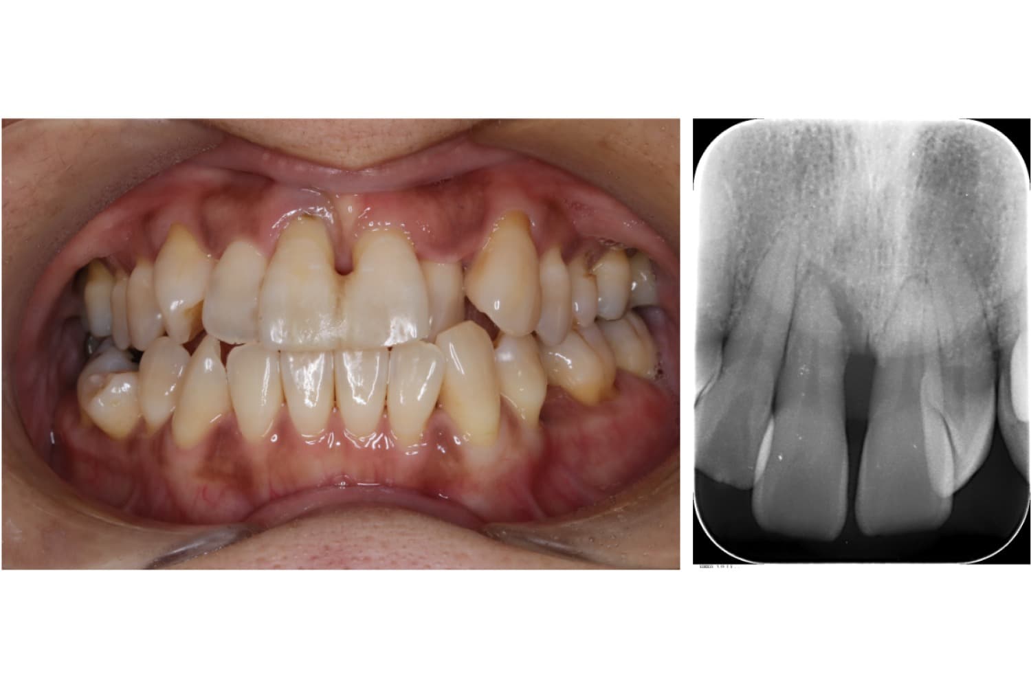 インプラント治療前