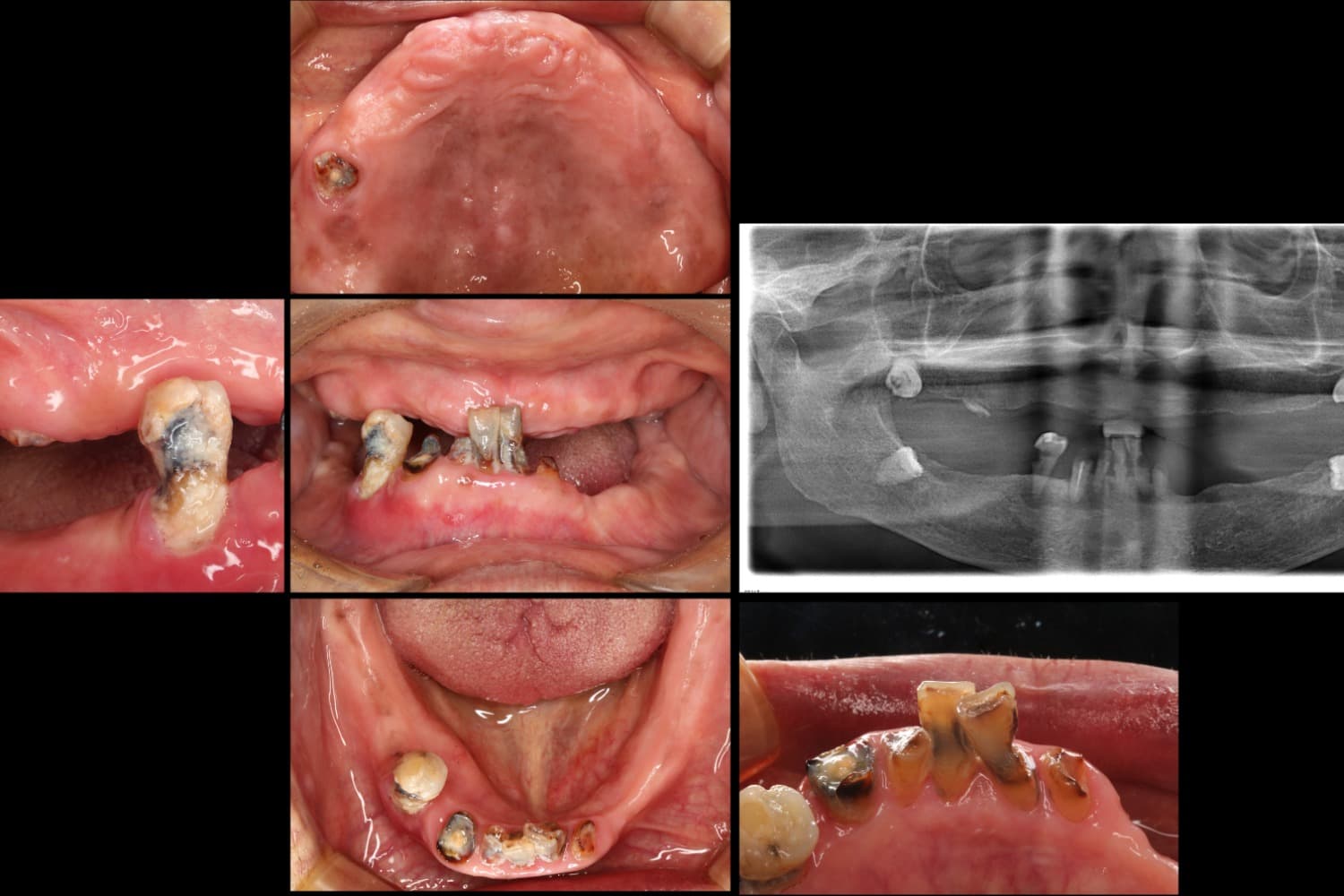 インプラント治療前