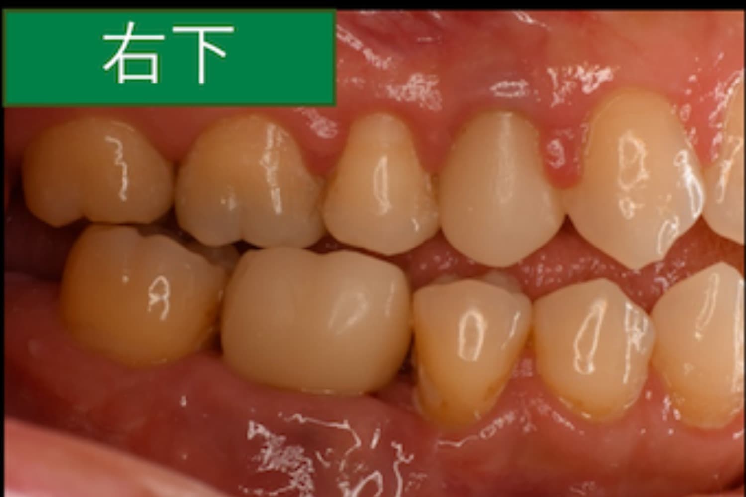 症例①インプラント治療後