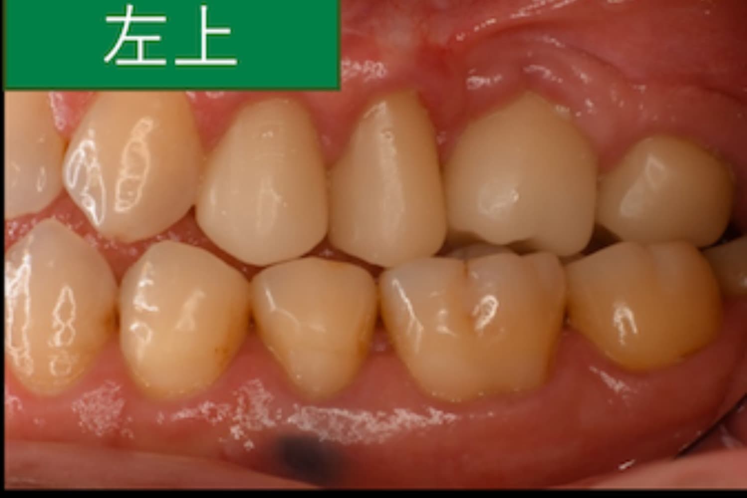症例①インプラント治療後