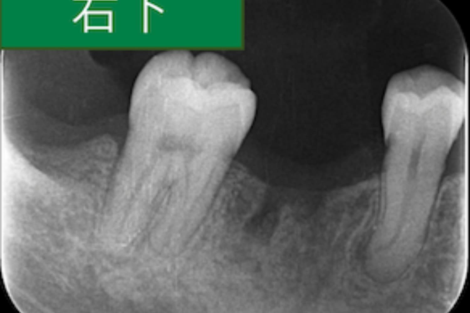 症例①インプラント治療前