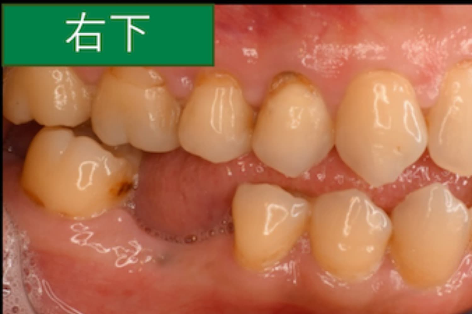 症例①インプラント治療前