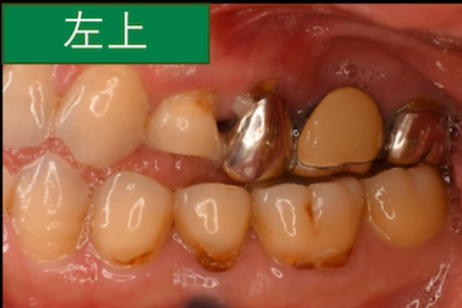 症例①インプラント治療前