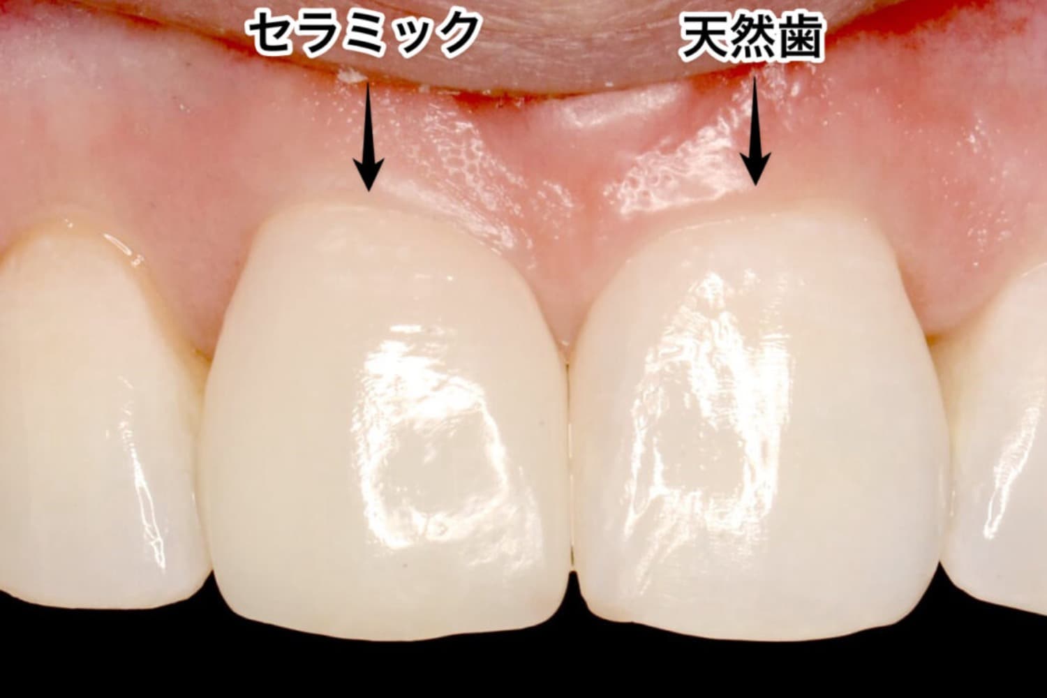 症例①矯正治療後