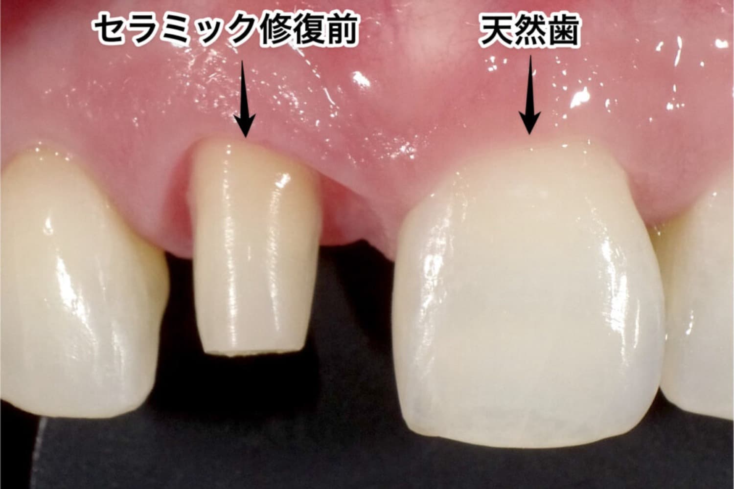 症例①矯正治療前