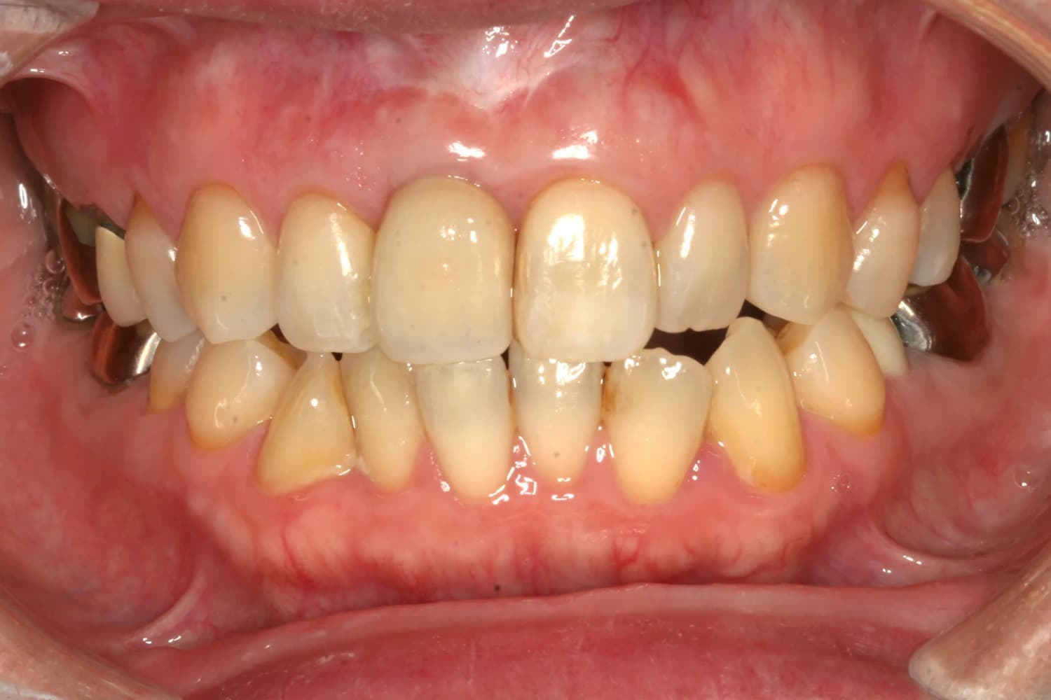 症例①インプラント治療後