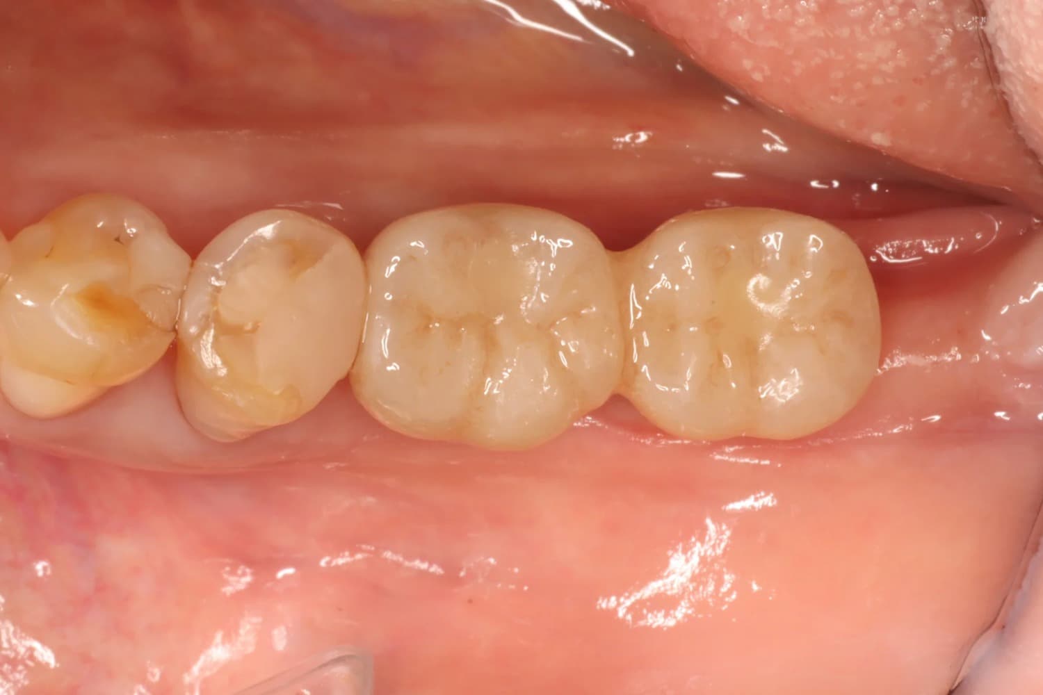 症例④インプラント治療後