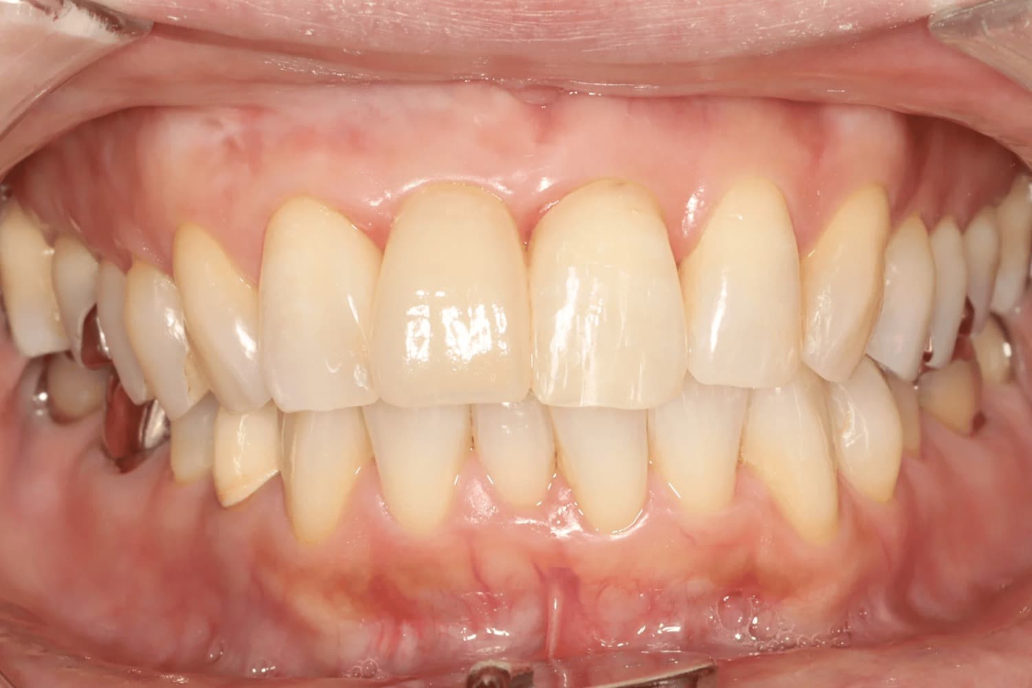 症例③インプラント治療後