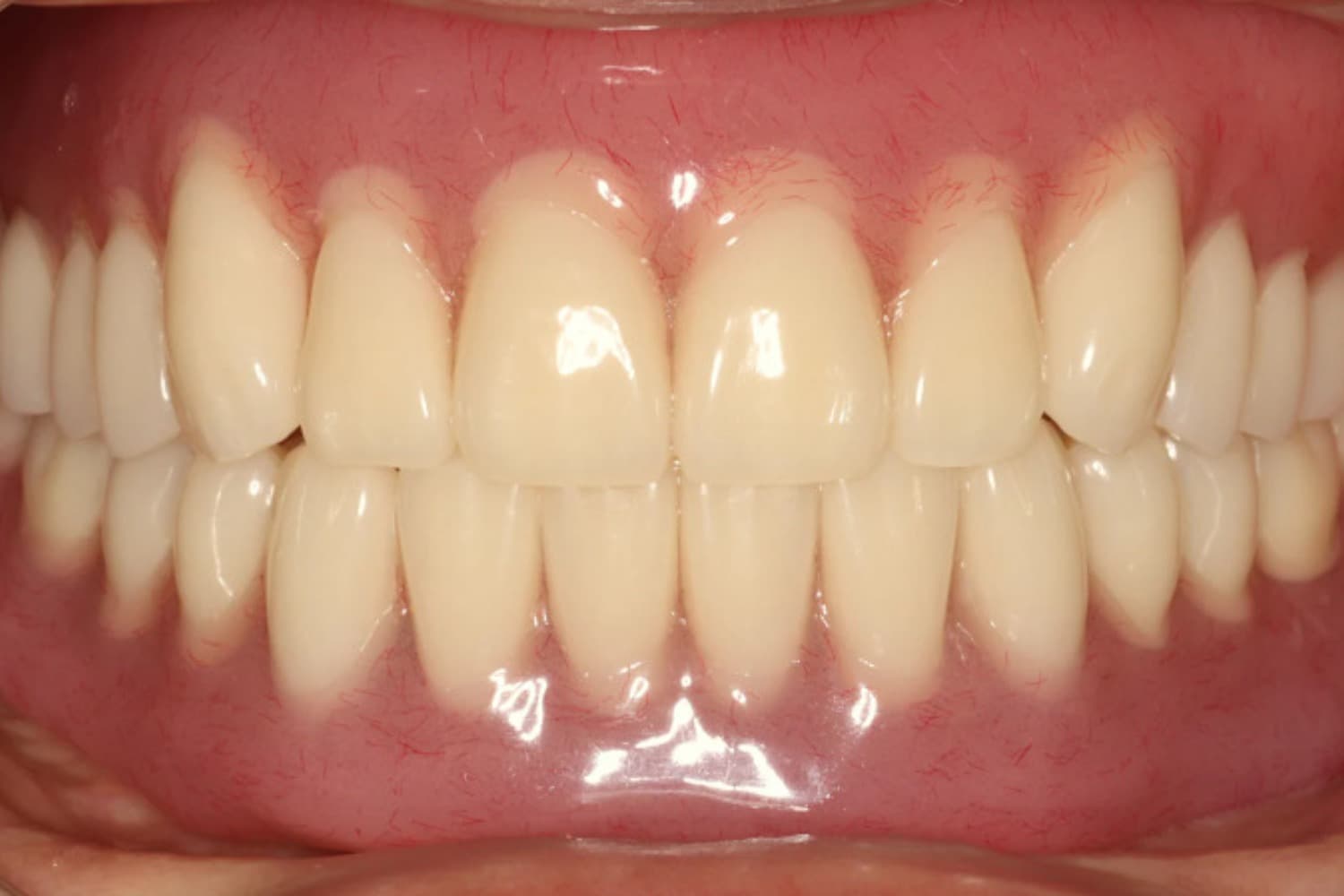 症例⑦インプラント治療後