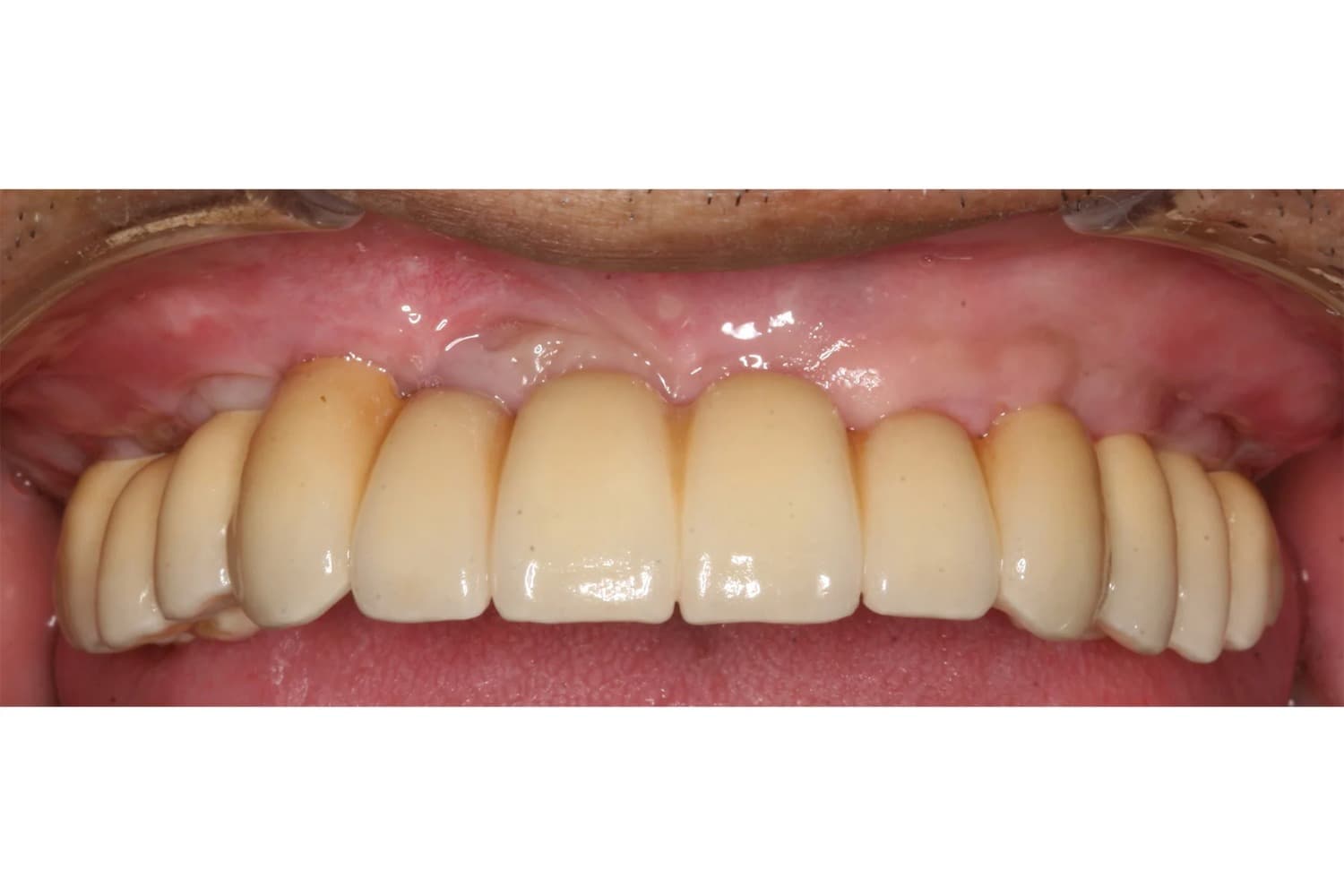 症例⑤インプラント治療後
