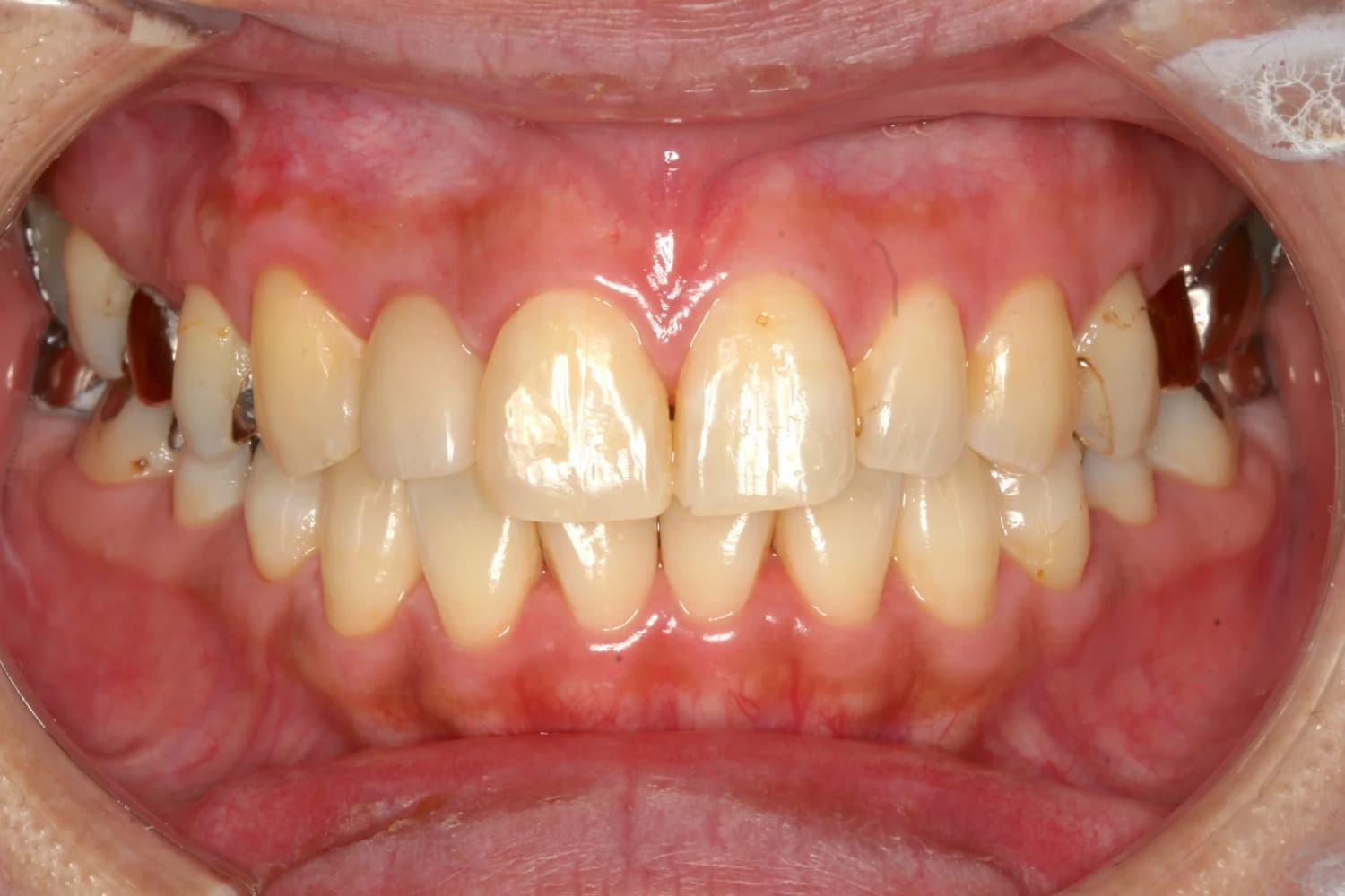症例②インプラント治療後
