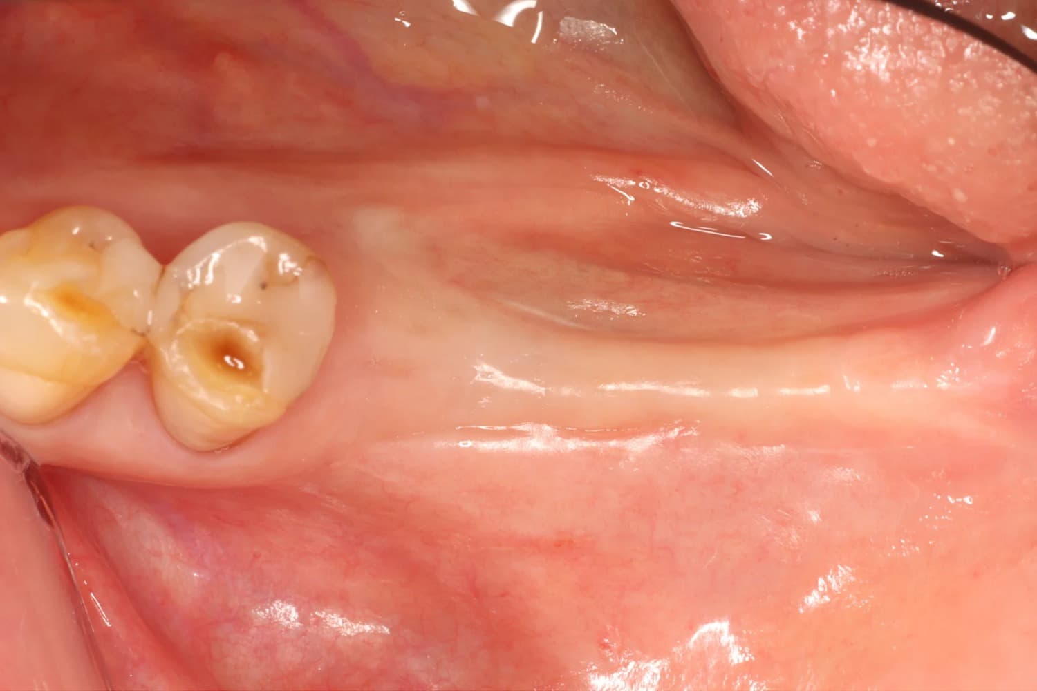 症例④インプラント治療前