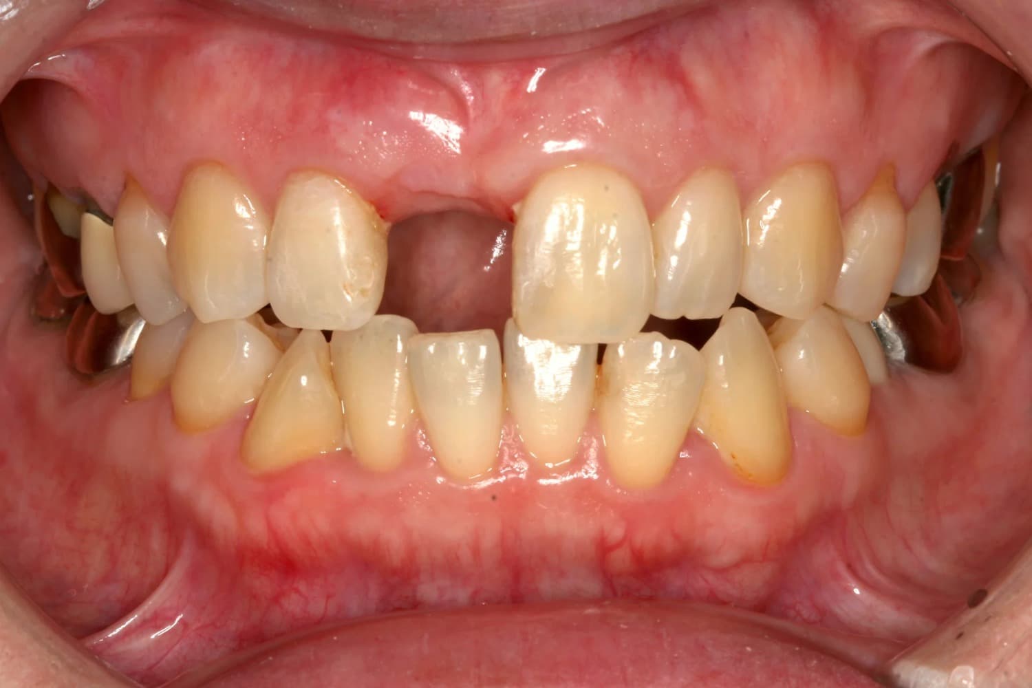 症例①インプラント治療前