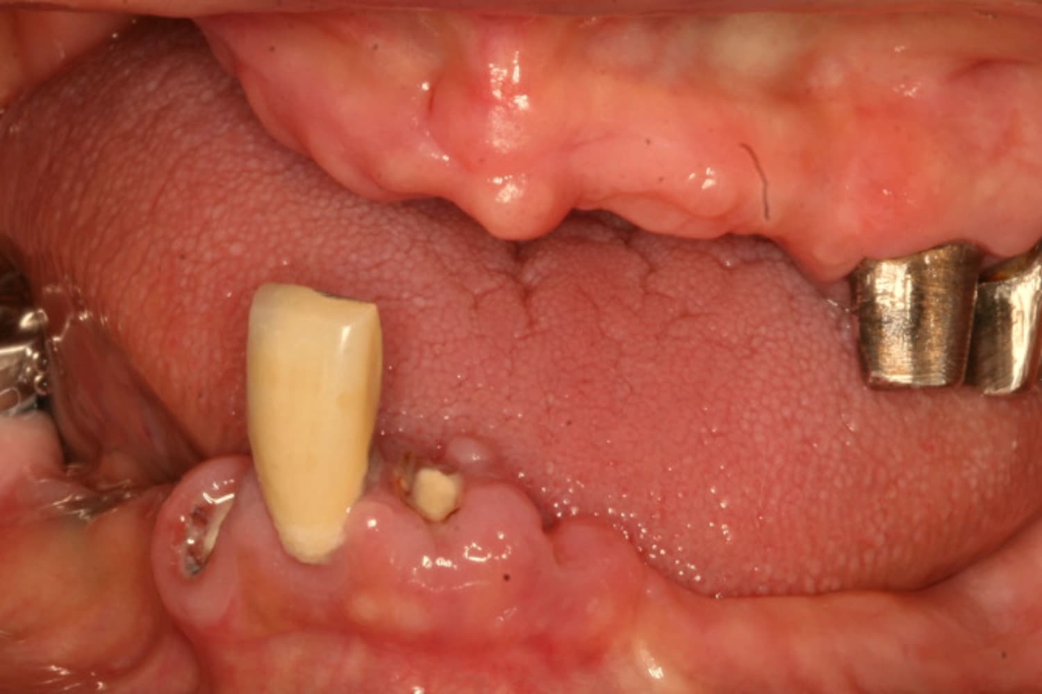 症例⑦インプラント治療前