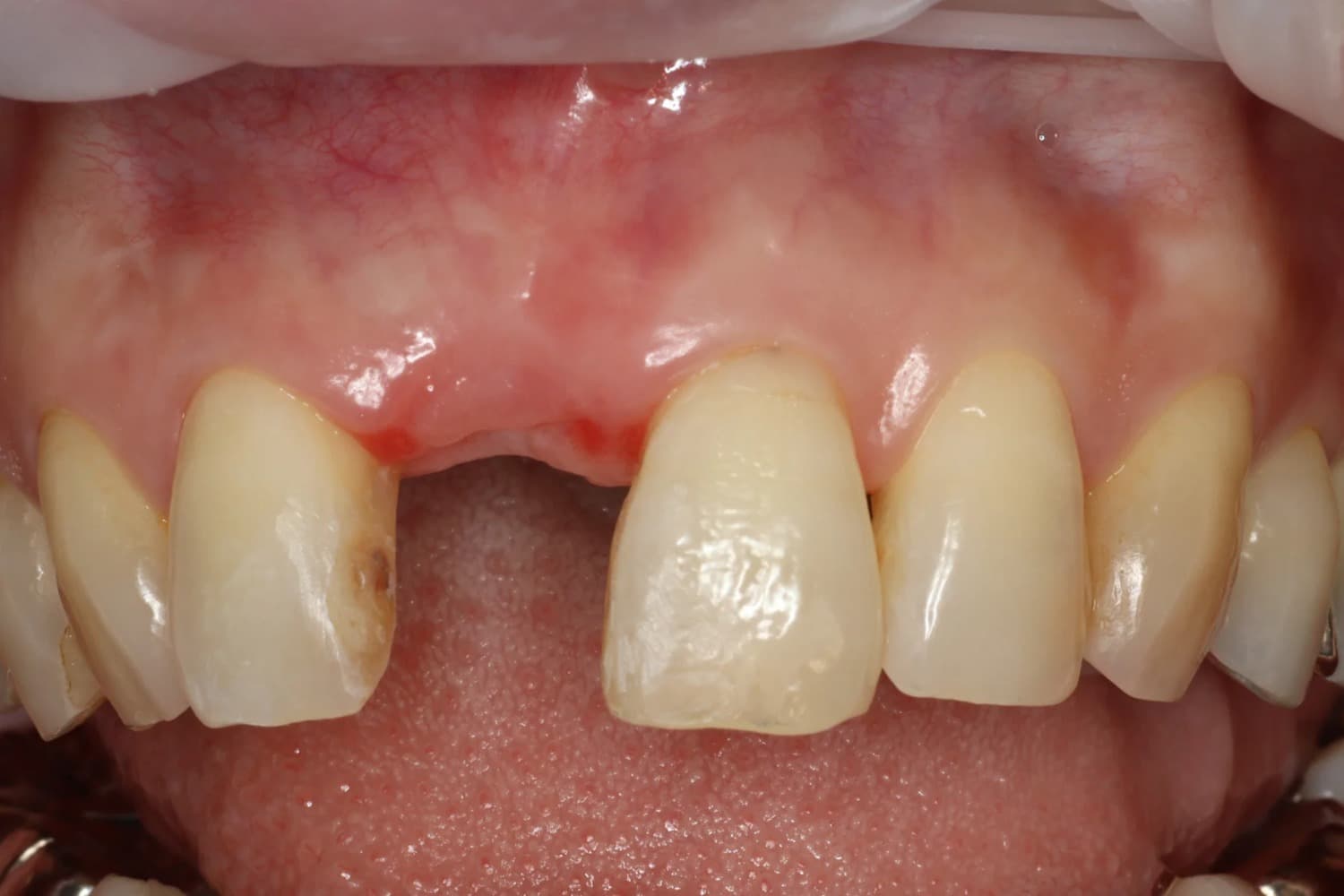 症例③インプラント治療前