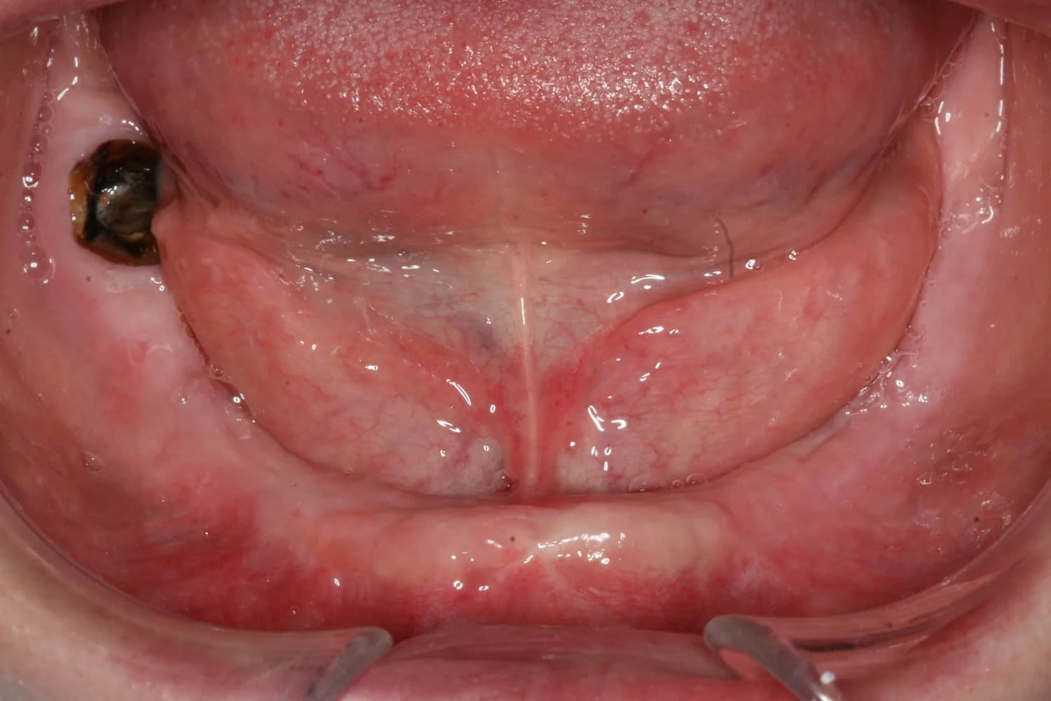 症例⑥インプラント治療前