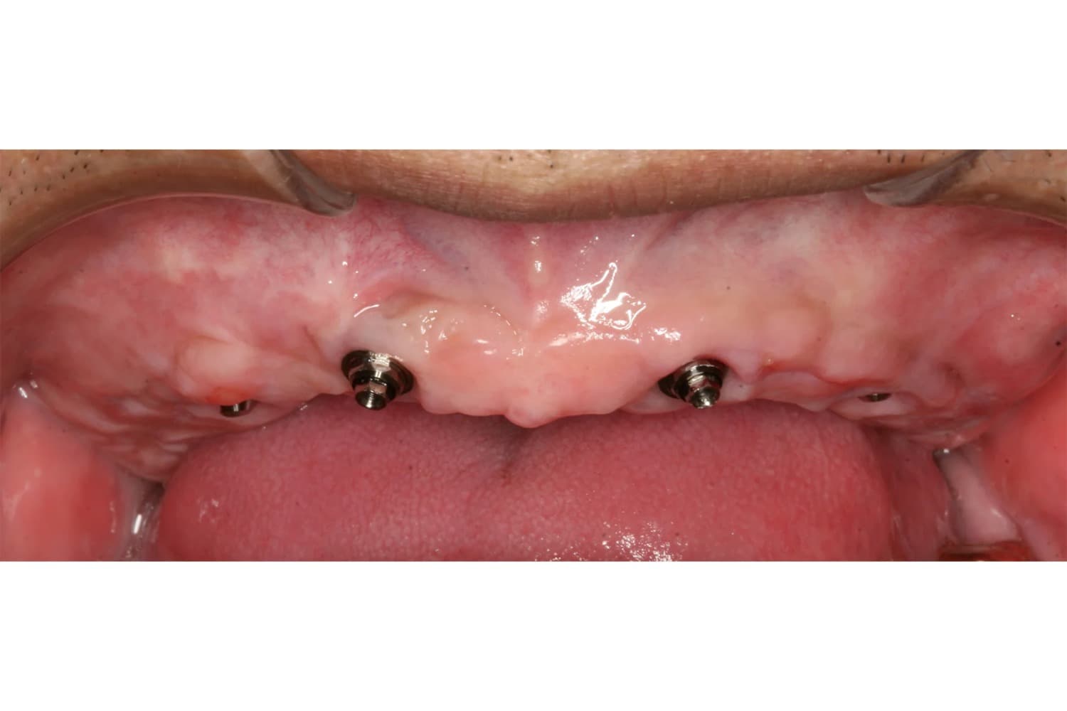 症例⑤インプラント治療前