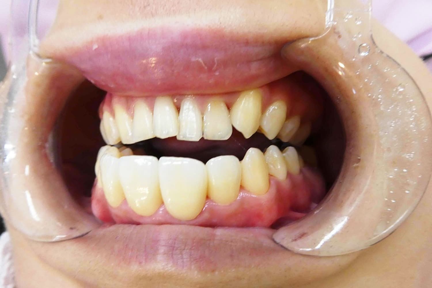 セラミック治療後