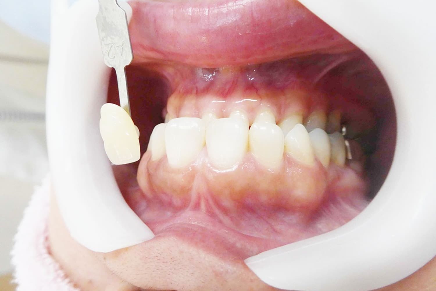 セラミック治療後