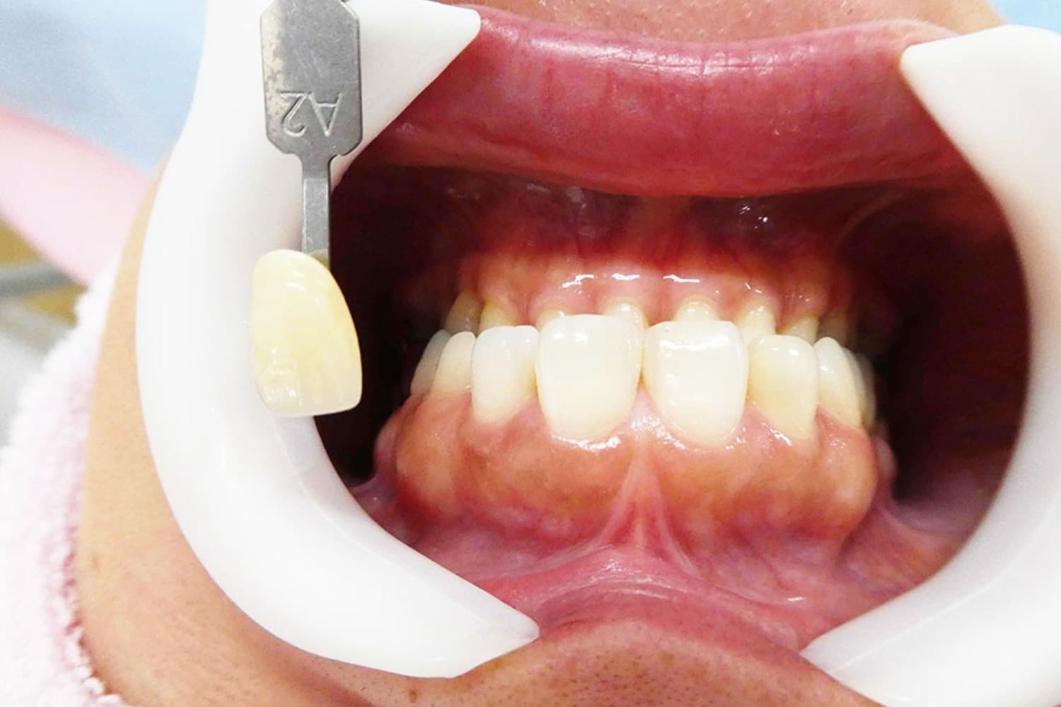 セラミック治療後