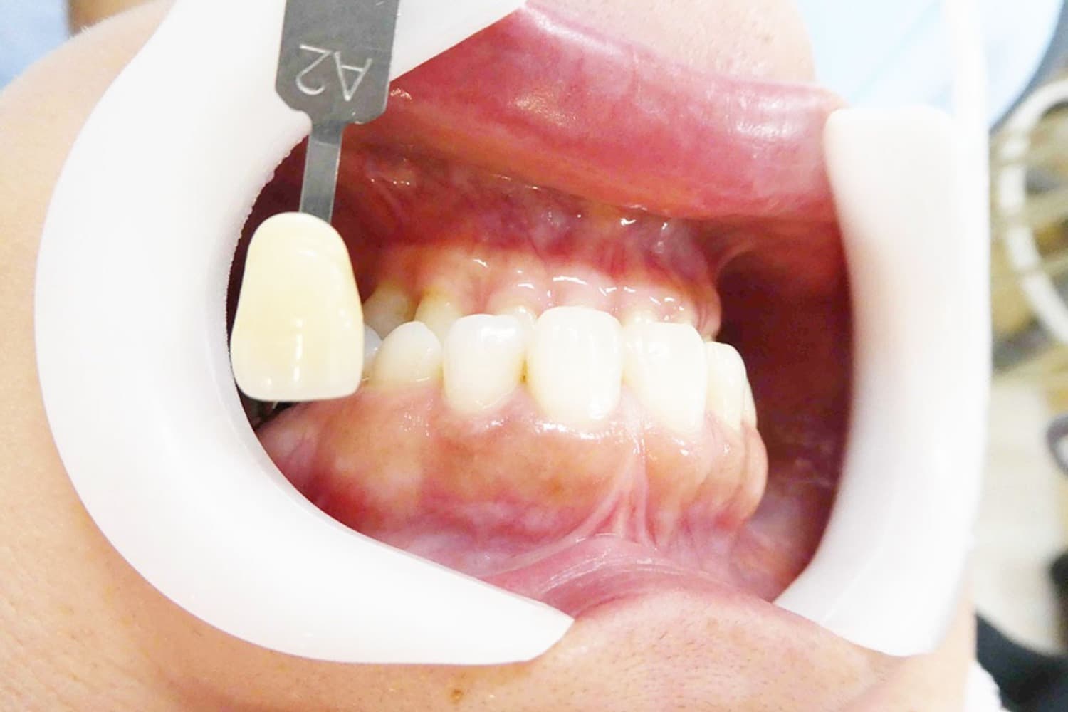 セラミック治療後