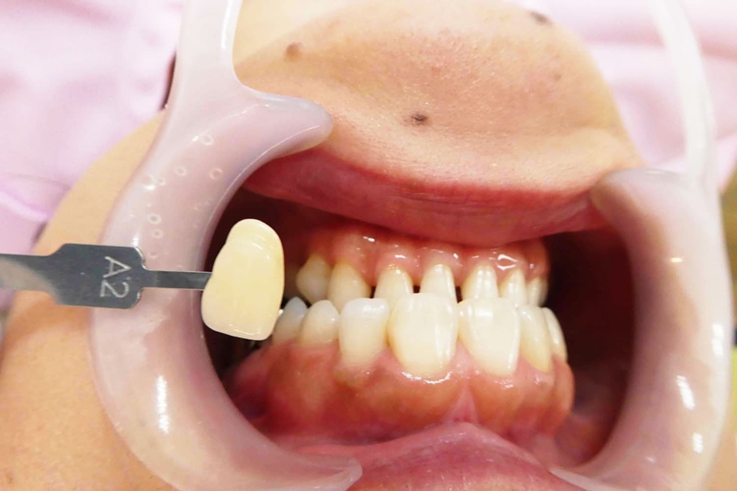 セラミック治療前