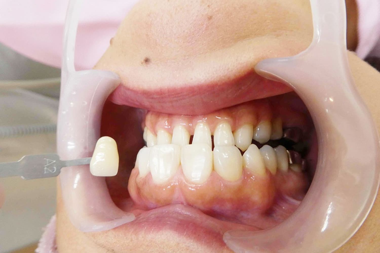 セラミック治療前