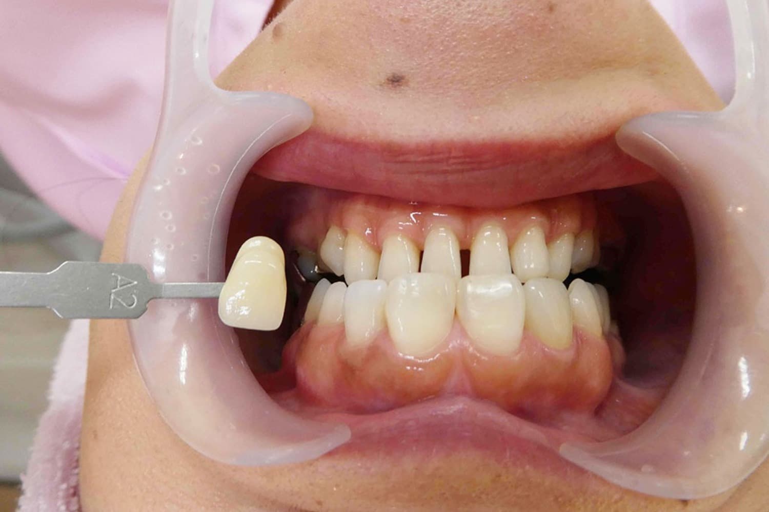 セラミック治療前