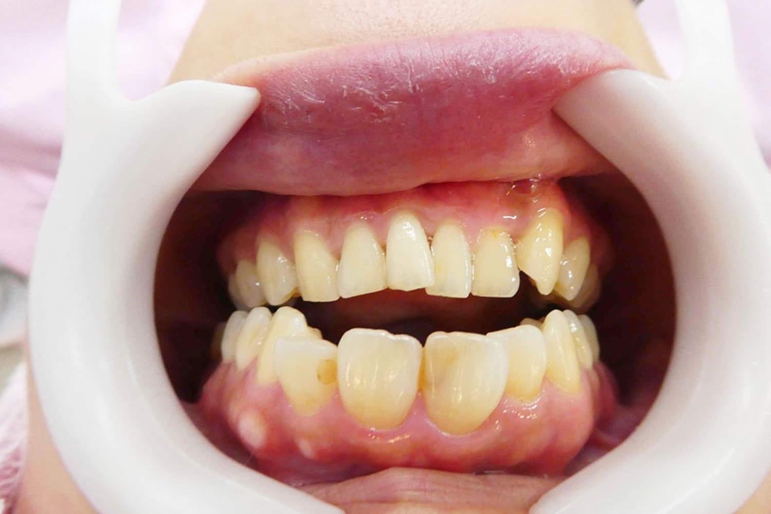 セラミック治療前