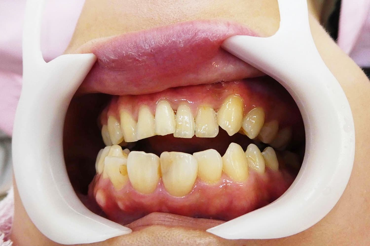 セラミック治療前