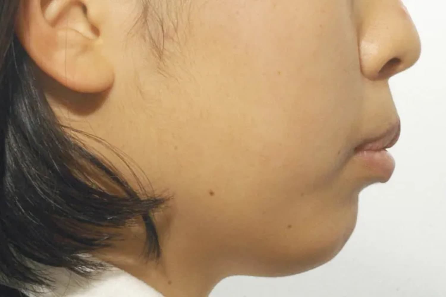 症例④矯正治療前