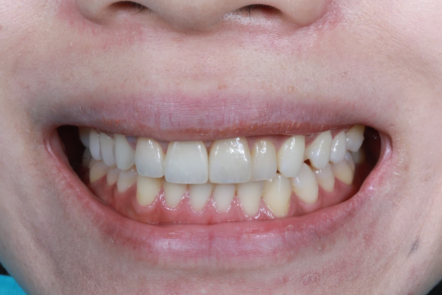 インプラント治療後1