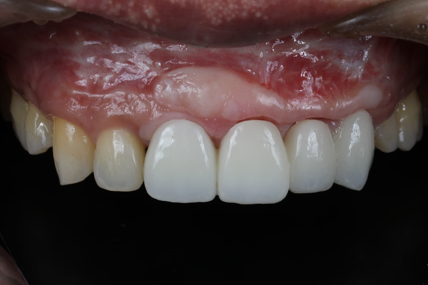 インプラント治療後4