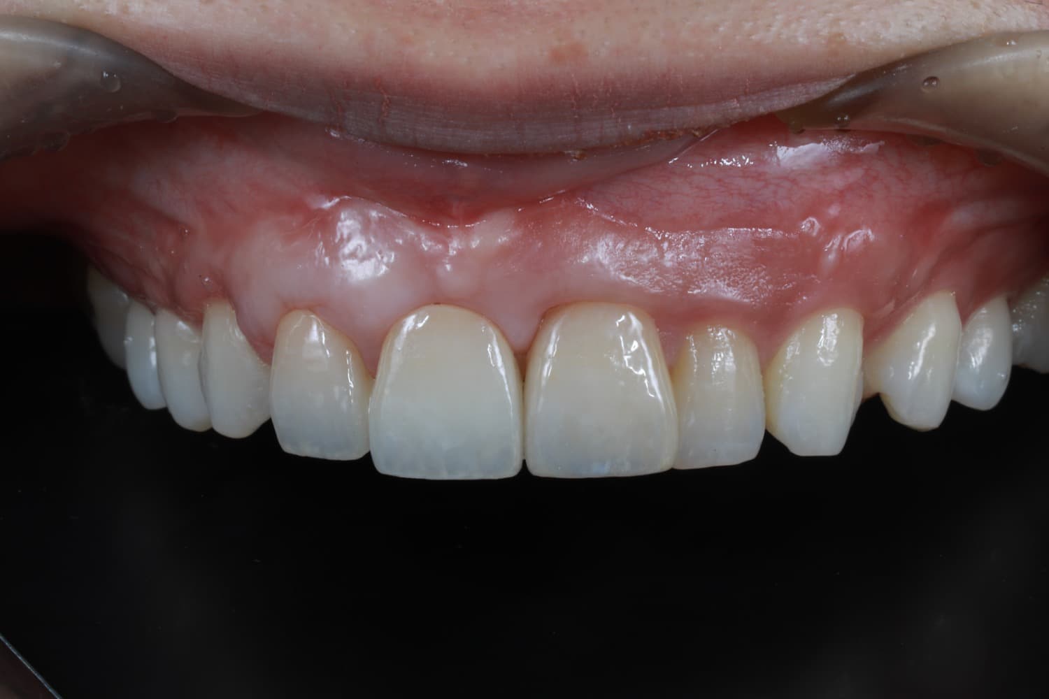 インプラント治療後2