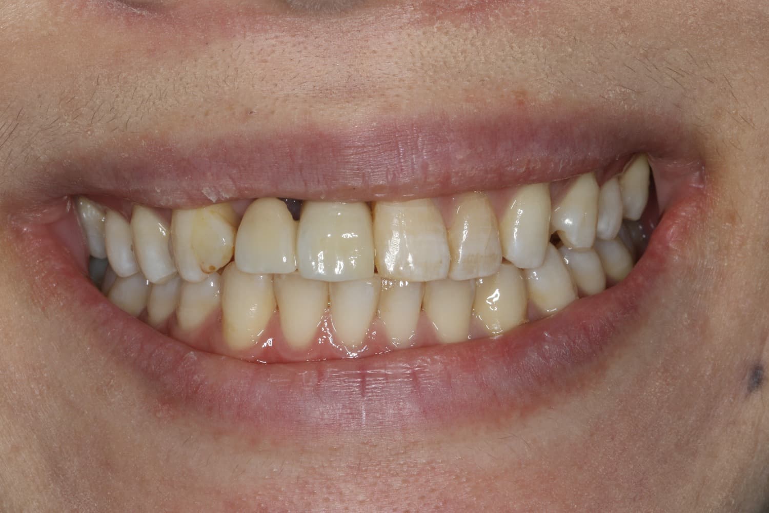 インプラント治療前1