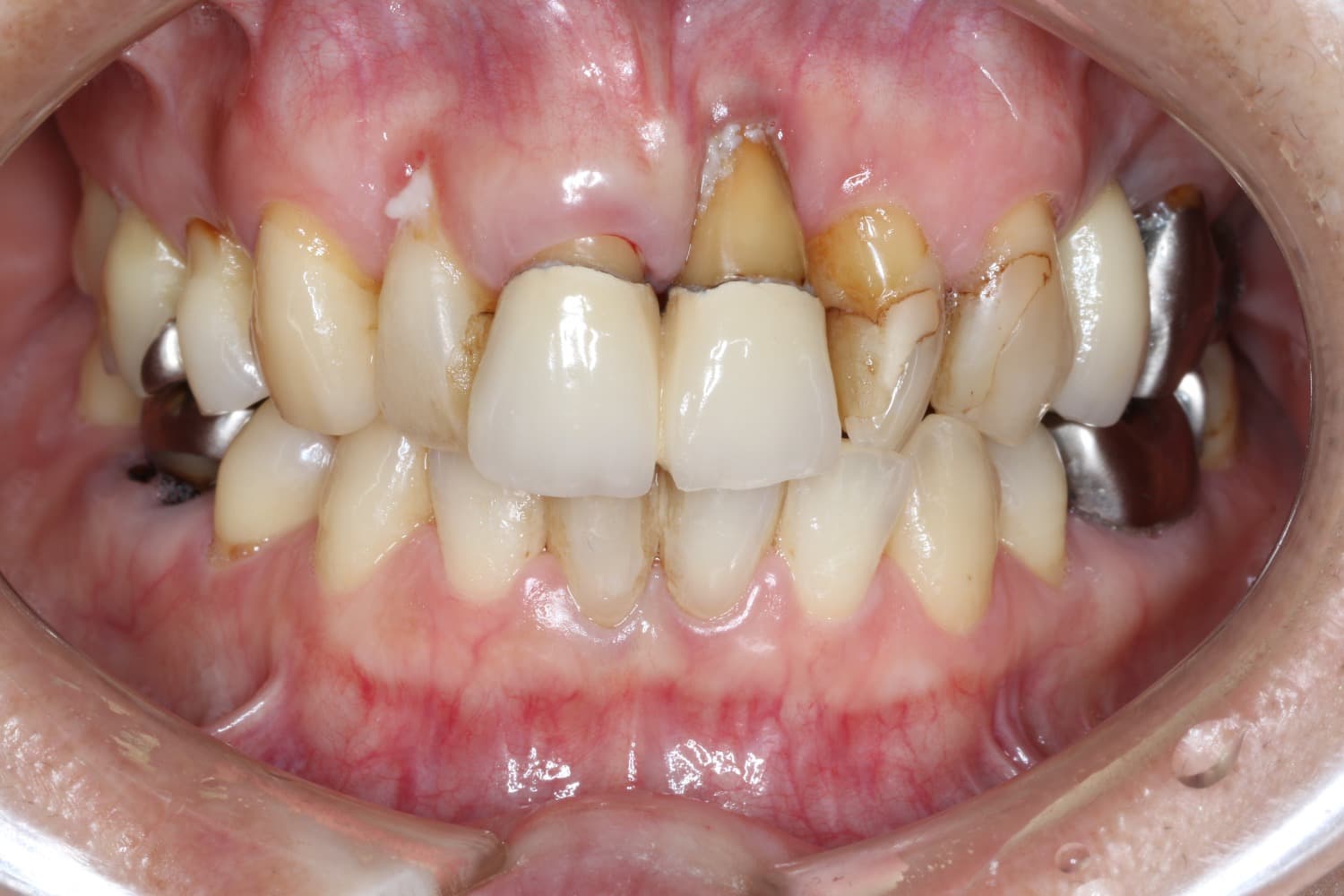 インプラント治療前5