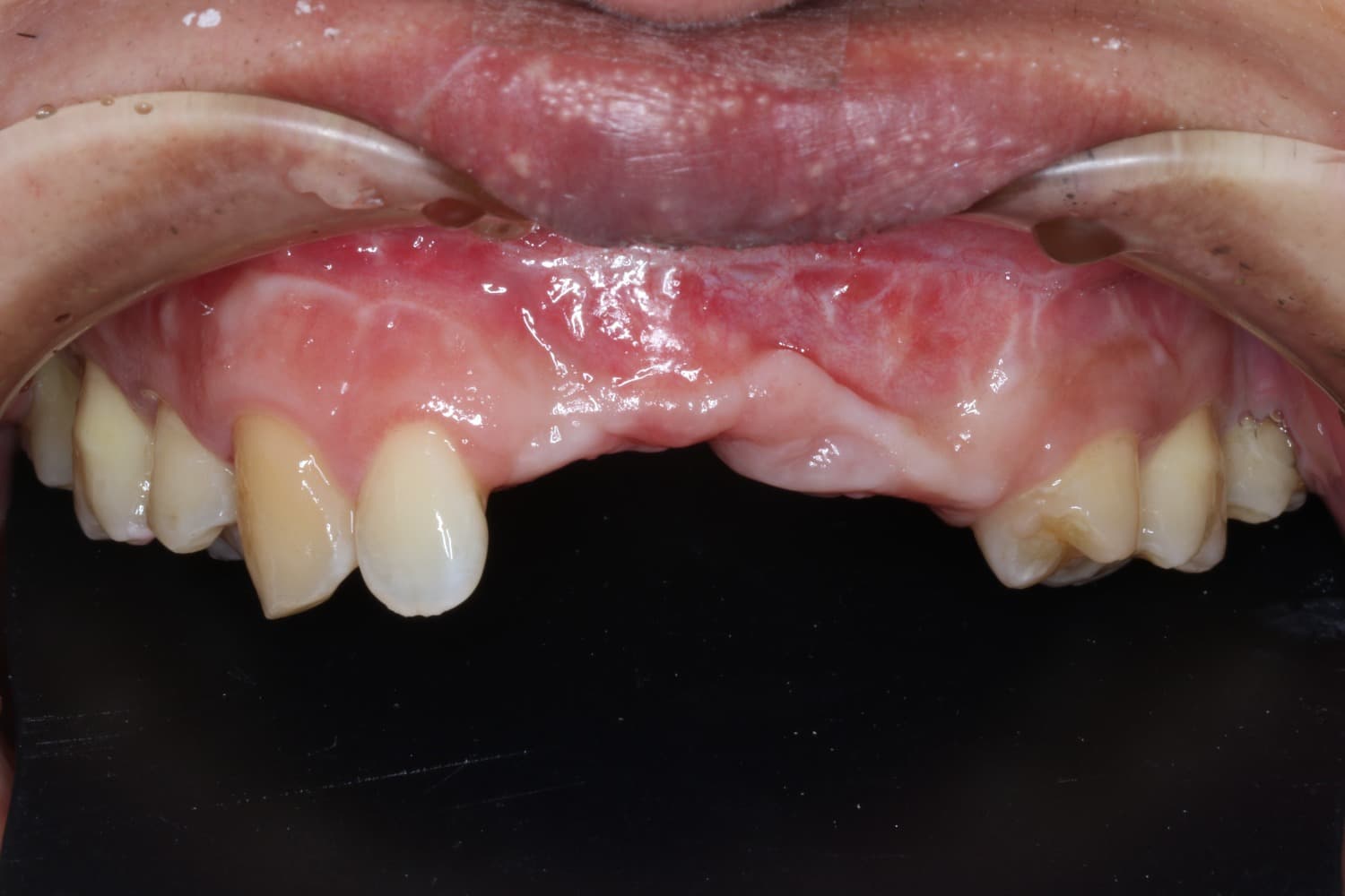 インプラント治療前4