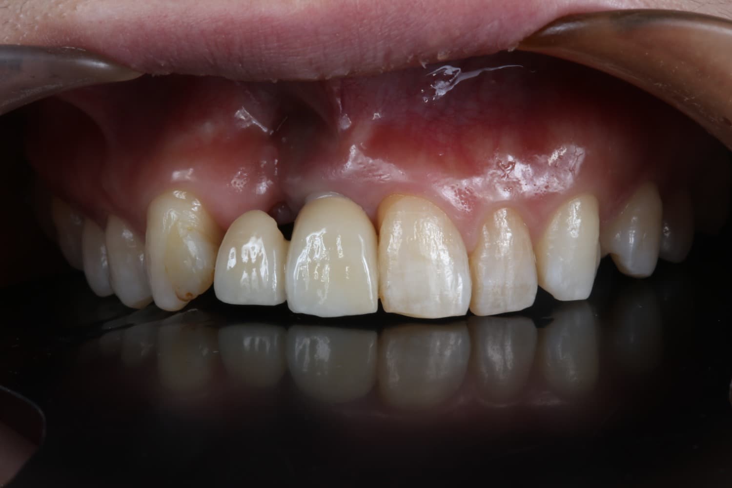 インプラント治療前2