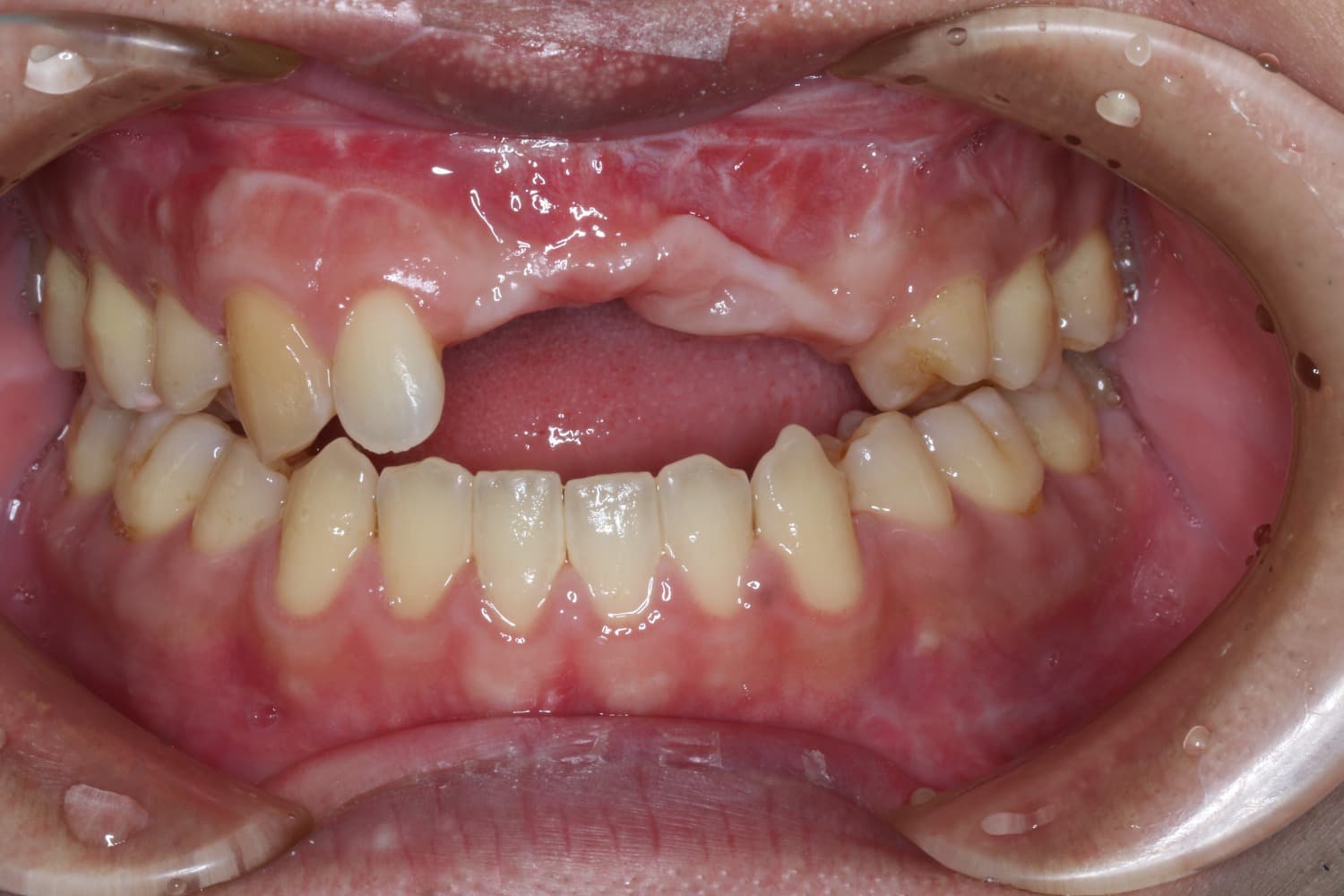 インプラント治療前3