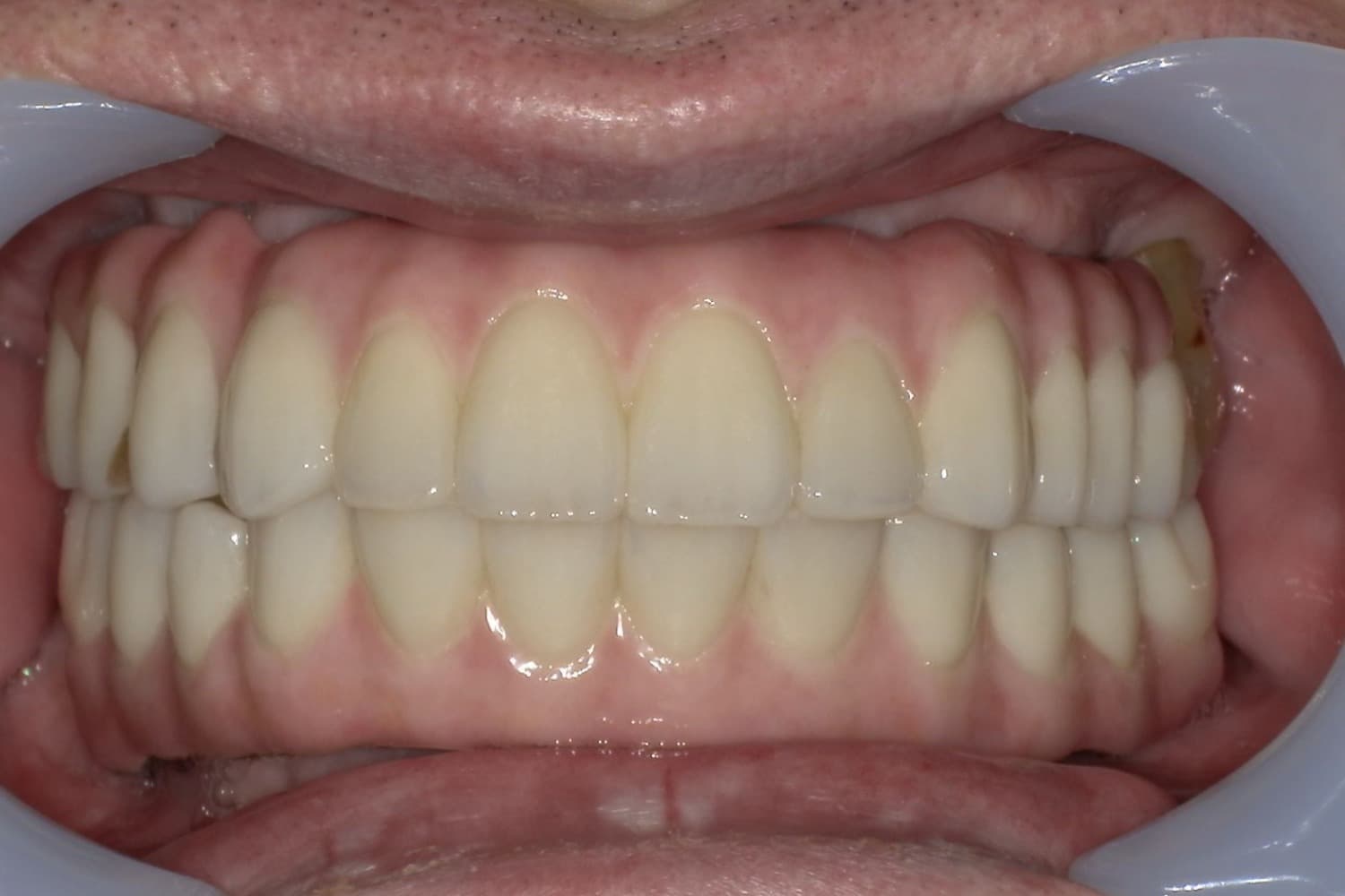 症例①インプラント治療後