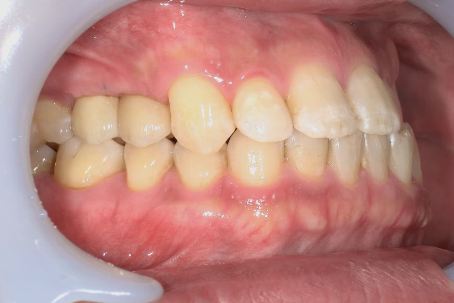 症例②インプラント治療後